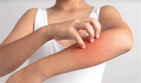 Urticaria: A Common Skin Condition Resulting In Itchy Hives - Allergy