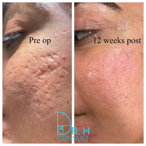 Acne Scar Laser Treatment & Removal London | Dr H Consult