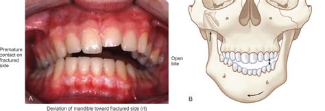 Fractures of the Condylar Process of the Mandible | Plastic Surgery Key