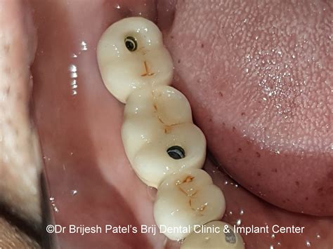 Dental Implants Image | Brij Dental Clinic