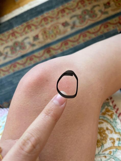 Scabies or Spongiotic Dermatitis?? : r/scabies