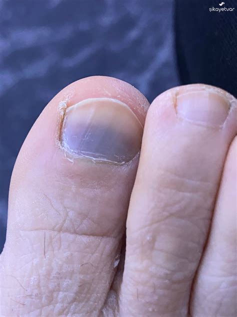 My Adidas Runfalcon 5 Shoes Caused Severe Foot Pain and Bruising - Xolvie