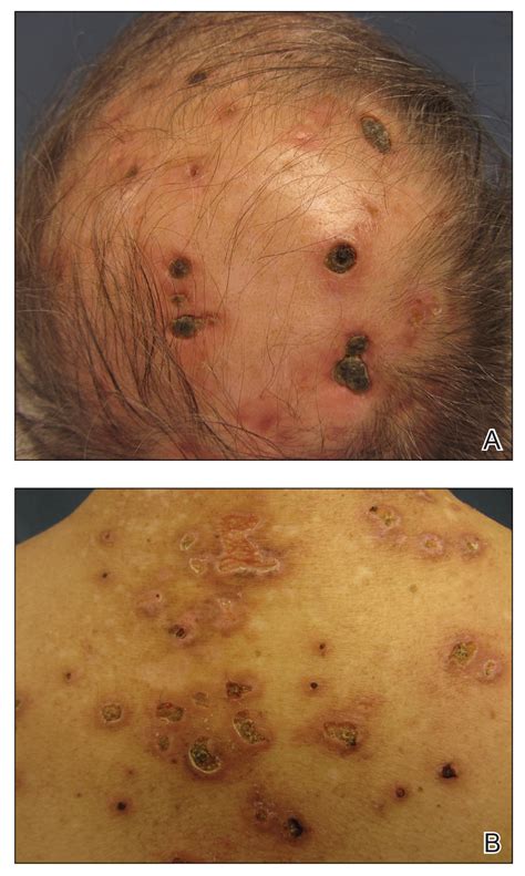 Lymphomatoid Papulosis Positive Diagnosis Forms