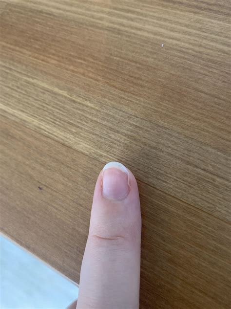 Nail detached on the side? : r/nailbiting