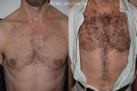 Body Hair Transplant photos | Miami, FL | Patient35060