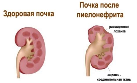 Нефрит - признаки, причины, симптомы, лечение и профилактика - iDoctor.kz