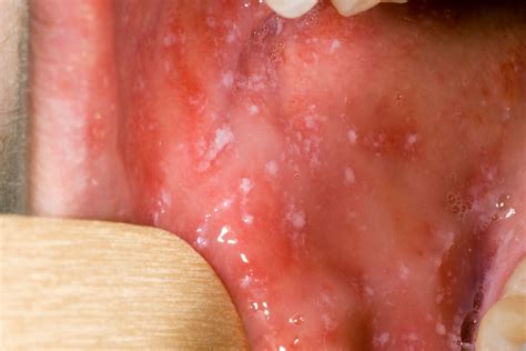 Measles: What it is and what GPs should look out for - Pulse Today