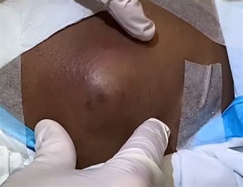 Huge Inflamed Cyst Pop - New Pimple Popping Videos