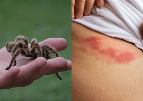 Pelo De Aranha Na Pele Como Tratar - ‘Cobreiro’ não vem de aranha: entenda o que realmente causa as lesões ...