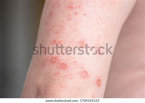 Aids Pictures Of Sores