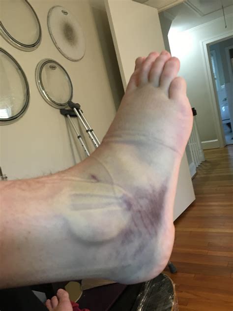 281 best Sprained Ankle images on Pholder | Neverbrokeabone, Aww and