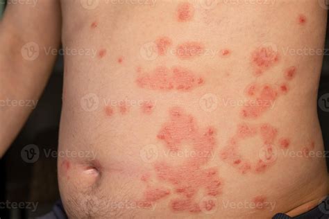 Red itchy patches on skin caused by psoriasis highlighting a common