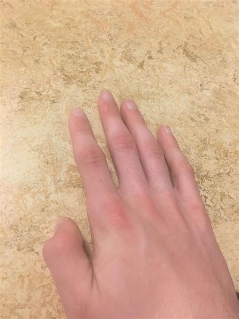 Why Is My Right Thumb Twitching? 5 Common Causes And Fixes 4