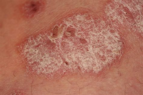 Psoriasis Skin Lesions