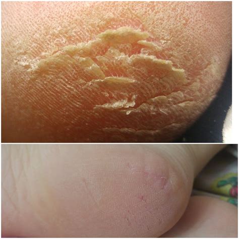 My foot before and after : r/peeling
