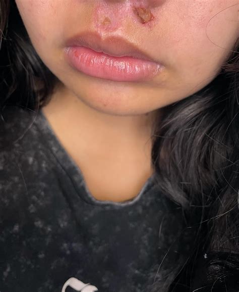 normal scab rwoundcare