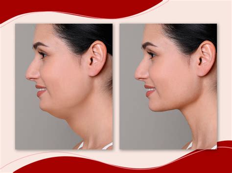 Lipo De Papada Enzimática Antes E Depois - Lipo de papada enzimática: Como funciona, valor e antes e depois