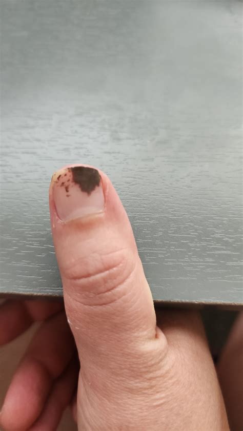 Silver Nitrate Stain : r/medical_advice