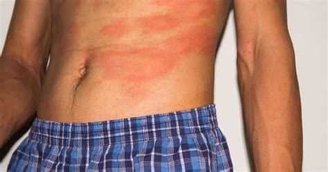 10 Additional Home Remedies for Eczema - Facty Health