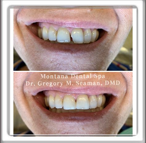 Smile Gallery — Montana Dental Spa