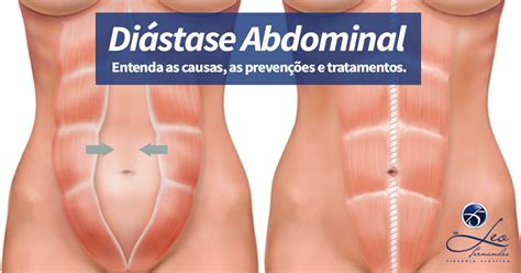 O Que É Diástase Abdominal - Diástase Abdominal O Que é - NAZAEDU
