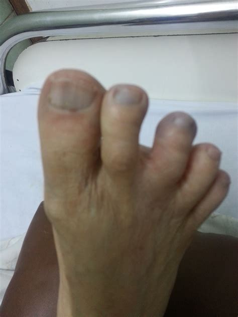 FOOT DEFORMITIES IN DIABETES - Diabetic Foot Clinic India