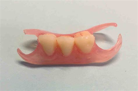 Valplast Flexible Partial Denture. | Dr. Gentry