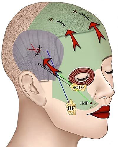 endoscopic facelift estepalace