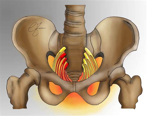 Pudendal Neuralgia Association, Inc.