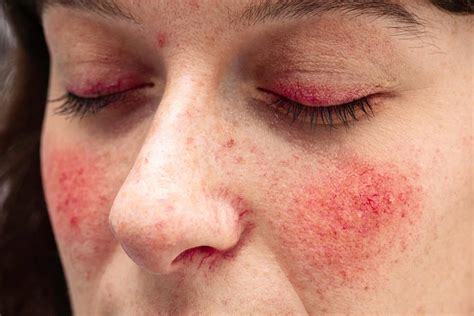 Common Causes of Rosacea: Sanford Dermatology: