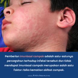 indonesia klb campak  rekomendasi tata laksana campak  anak