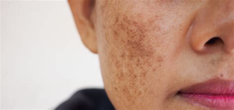Melasma | Dermatology and Skin Health - Dr. Mendese