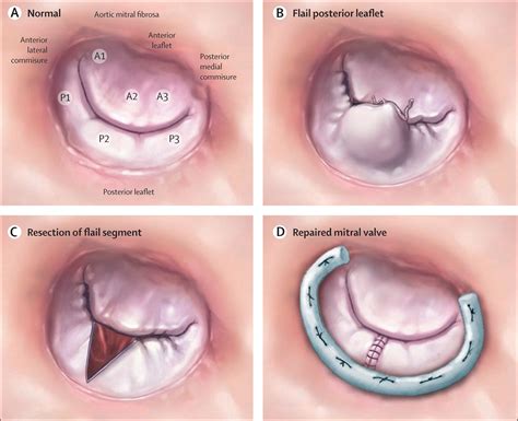 Mitral regurgitation - The Lancet