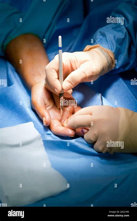 ganglion removal surgery close    orthopaedic surgeon removing