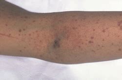 Immune Thrombocytopenia and Purpura