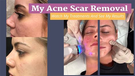 acne scar treatment japan  nancy milne blog