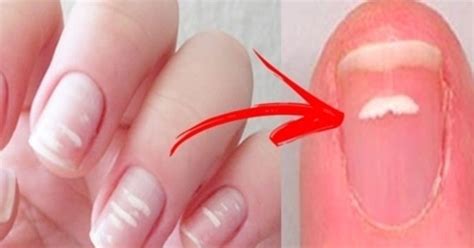 Porque A Unha Fica Com Manchas Branca - Por Que Nos Aparecem Manchas Brancas Nas Unhas – QCSD