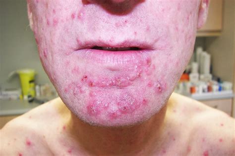35 Facts About PAAND (Pyrin-associated Autoinflammation With