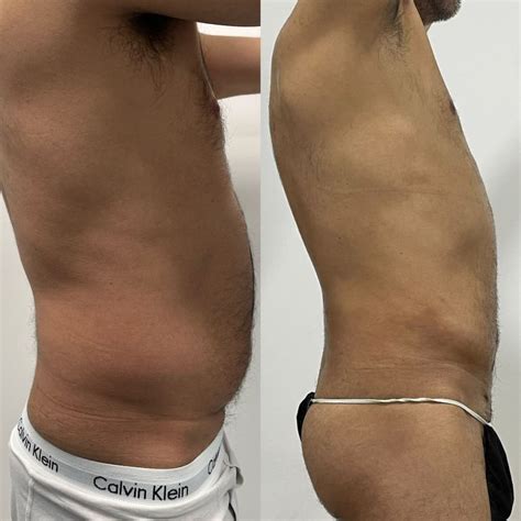 Lipopress Antes E Depois - Cuidados antes y después de una Liposucción - TEKDERMA