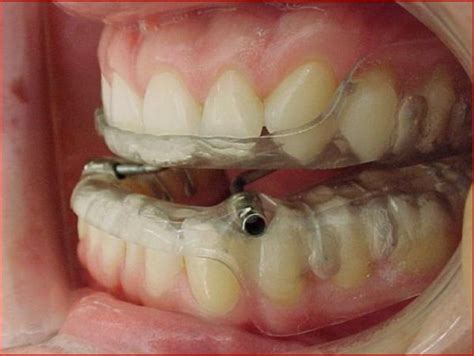 neosono clinical practice guideline   treatment  obstructive