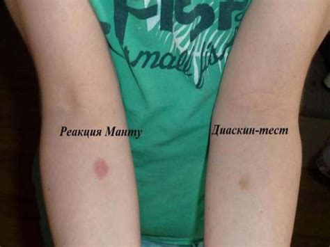 Манту сынамасы. Диаскинтест - презентация онлайн