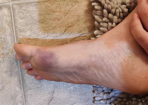 Bruised ball of foot with acute numbness. : r/DiagnoseMe