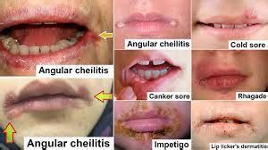 paper  angular cheilitis dentist isle  man