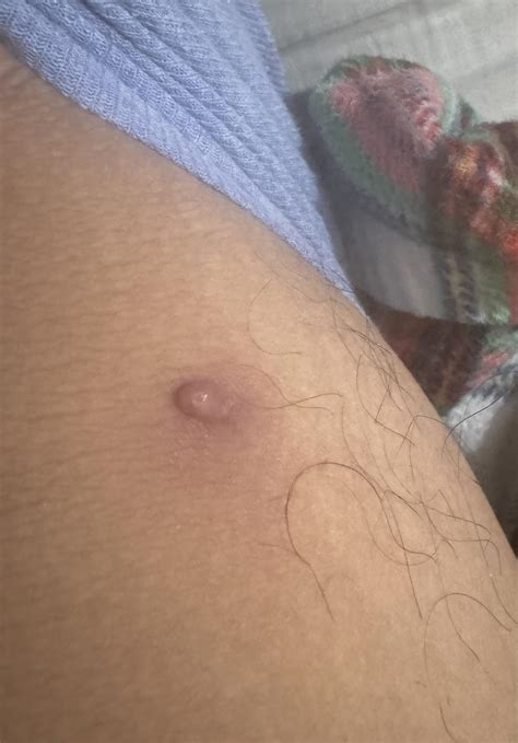 Skin tag inner right thigh tender to touch : r/skin