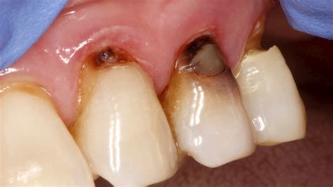 Exposed Tooth Root: Treatment in Spring Orchid Dental Clinic
