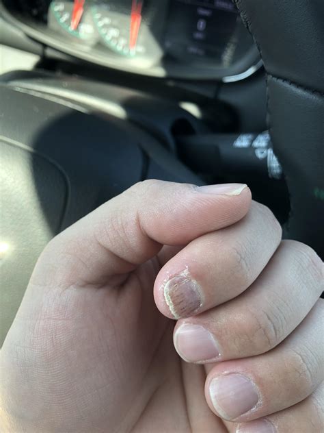 Advice to start treating nail fungus? Tried Vick’s and emuaid. Been