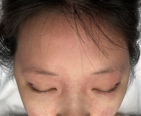 female custom brow bone implant front 1 Dr Barry Eppley Indianapolis