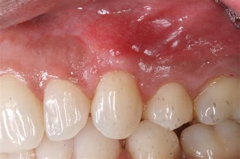 mucogingival therapy gum disease gingivitis