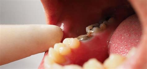 Tooth Decay Stock Photos, Images and Backgrounds for Free Download