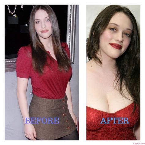 Surgery4 ⋆ Celebs Plastic Surgeries Pics [Before & After]